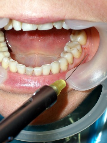 拔牙常用的麻醉方法有哪些?