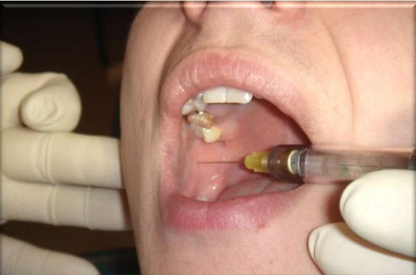 拔牙常用的麻醉方法有哪些?